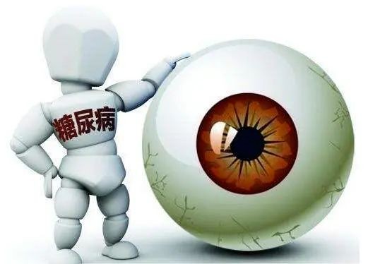 甜蜜的负担——糖尿病性视网膜病变